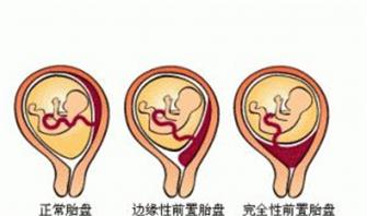 二胎妈妈应该知道这个，前置胎盘太危险！钦州市二医院成功救治凶险性前置胎盘产妇